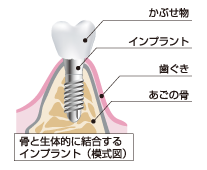 インプラントとは？